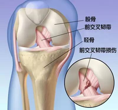 前交叉韧带1-2度损伤能自愈吗,前交叉韧带损伤一年还疼怎么回事