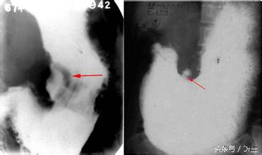 吃了午饭就恶心想干呕打嗝,一吃饭就恶心想吐反胃打嗝胀气