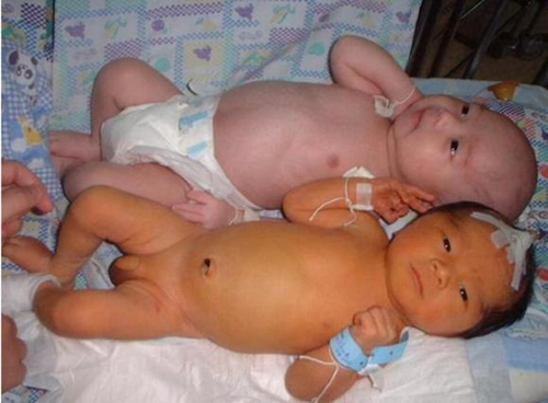 吃什么去胎毒黄疸最有效,初生儿去黄疸的药