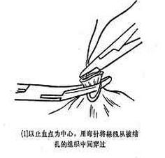 女性结扎以后复通手术全过程,女性结扎的手术步骤