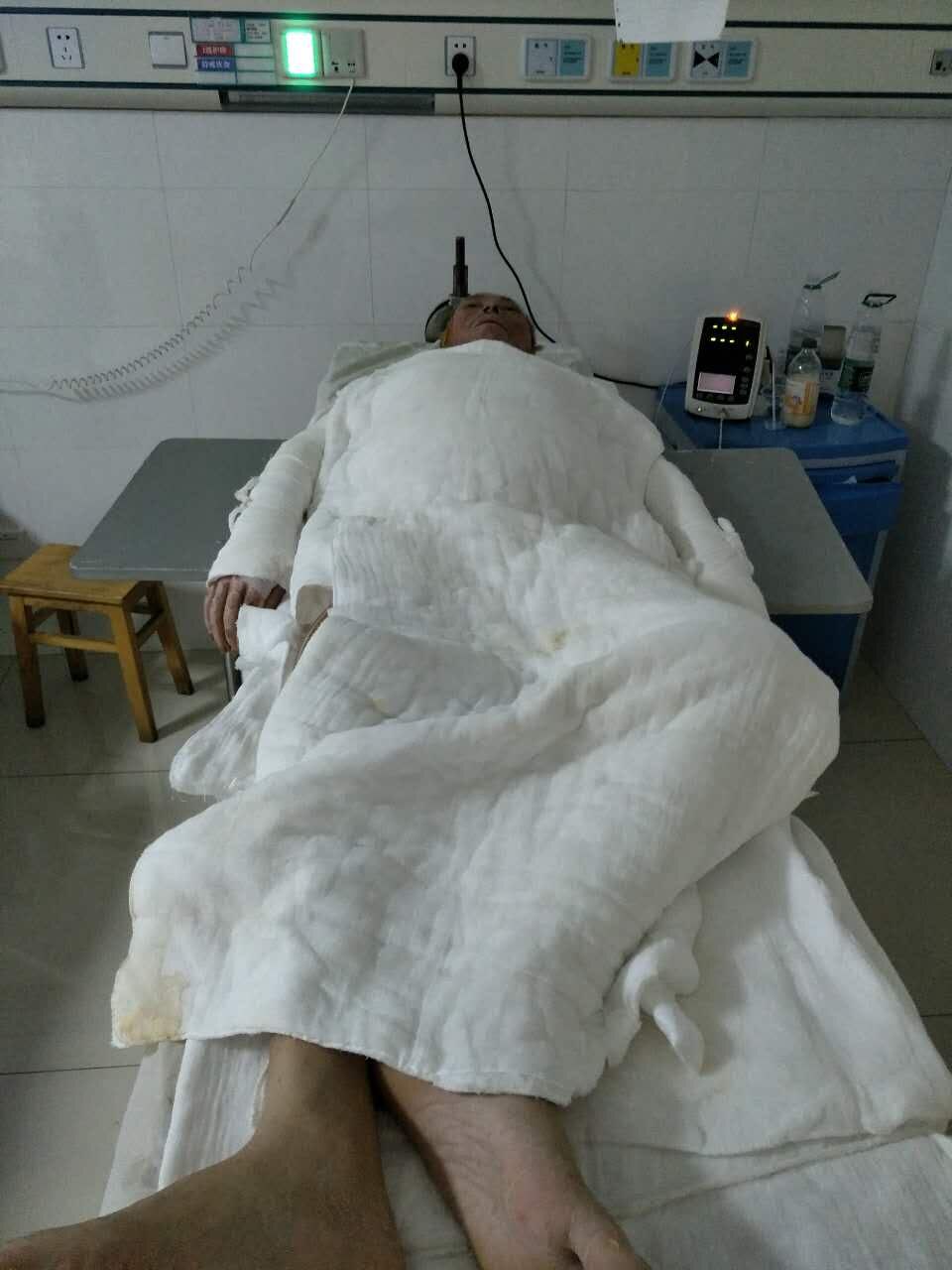 父亲大面积烧伤放弃治疗,一位6岁男孩父亲重度烧伤