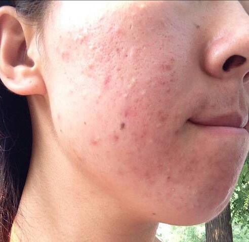 脸上毛孔大是有螨虫吗,螨虫脸上的毛孔挤出白色条状物