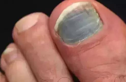 跑步1000米岔气怎么办,5步解决跑步黑指甲