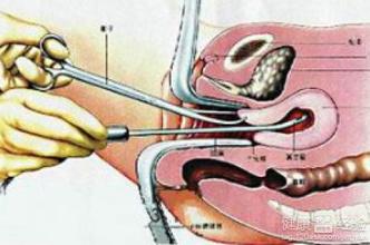 无痛人流和不无痛人流区别是什么,人流可以无痛吗