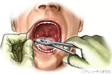 拔牙后发烧是怎么回事如何处理,拔牙后发烧疼痛怎么缓解