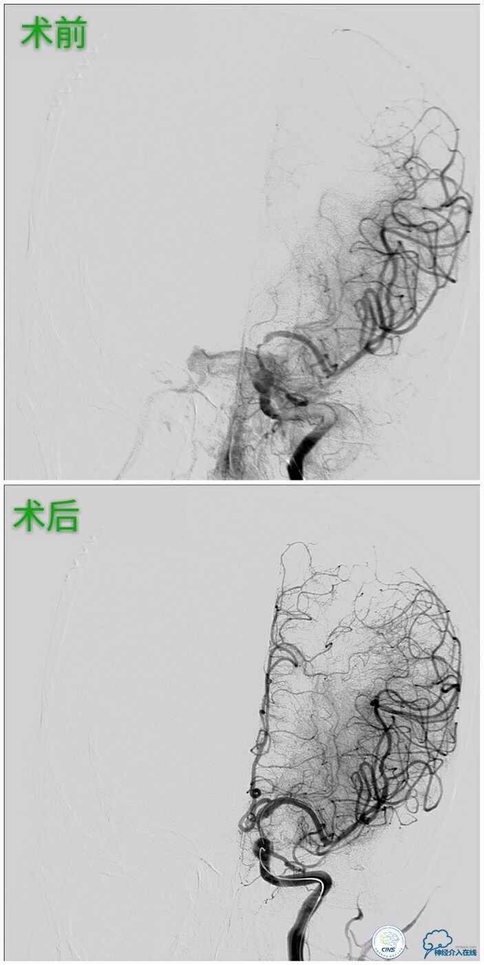 脑血管介入培训基地,脑卒中血管介入治疗