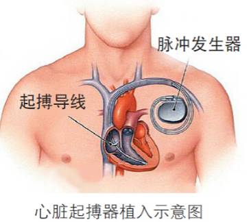 心源性猝死五大特征,心源性猝死的15个征兆
