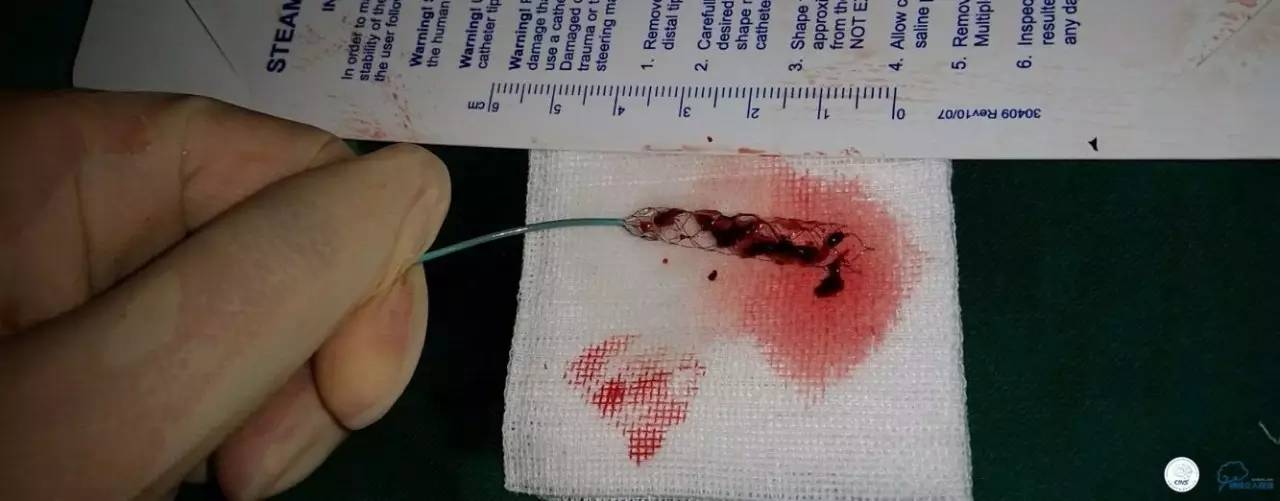 下肢血栓微创介入治疗的费用,急性深静脉血栓形成的诊断和治疗