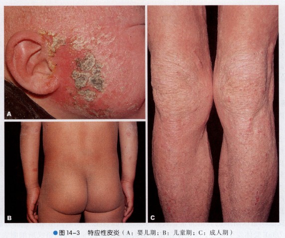 孩子反复湿疹皮炎怎么回事,儿童湿疹久治不愈变成特异性皮炎