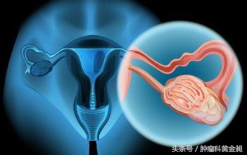 我是如何从中医方向来认识宫颈癌治疗的