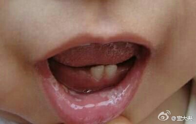 宝宝鹅口疮妈妈有没有要忌口的,宝宝鹅口疮宝妈怎么治