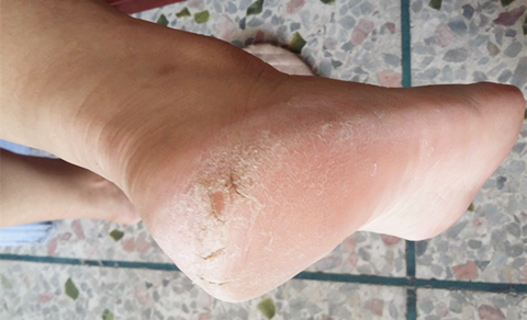 脚部干裂严重怎么办,脚部干裂怎么解决图片大全