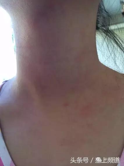 她年年吃螃蟹都没事，今年吃却满身长紫斑还尿血！为啥？