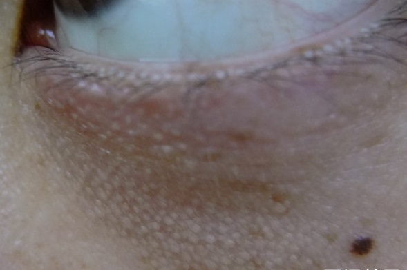 眼睛上边有个小颗粒,眼睛上有个米粒大小的颗粒