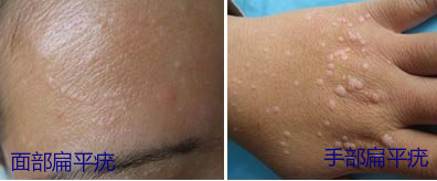 眼睛上边有个小颗粒,眼睛上有个米粒大小的颗粒