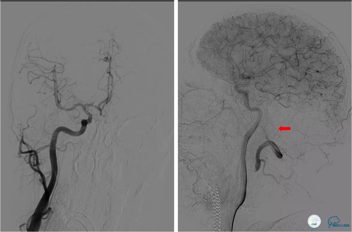后循环系统梗死,后循环梗死