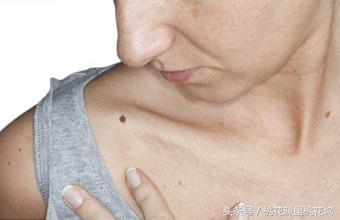 如何预防皮肤癌,晒太阳如何预防皮肤癌