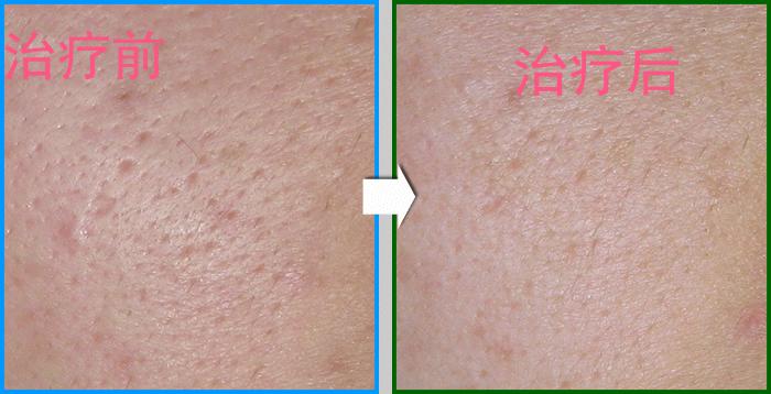 油性皮肤长痘痘如何遮盖,油皮肤容易长痘怎么办