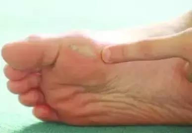 跑步怎么预防脚趾头起水泡,跑步起水泡怎么处理好得快