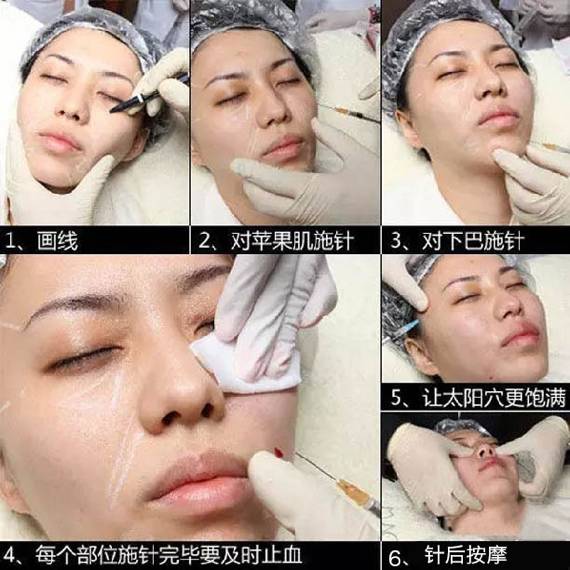 王菲的童颜针是什么牌子,王菲代言的童颜针好吗