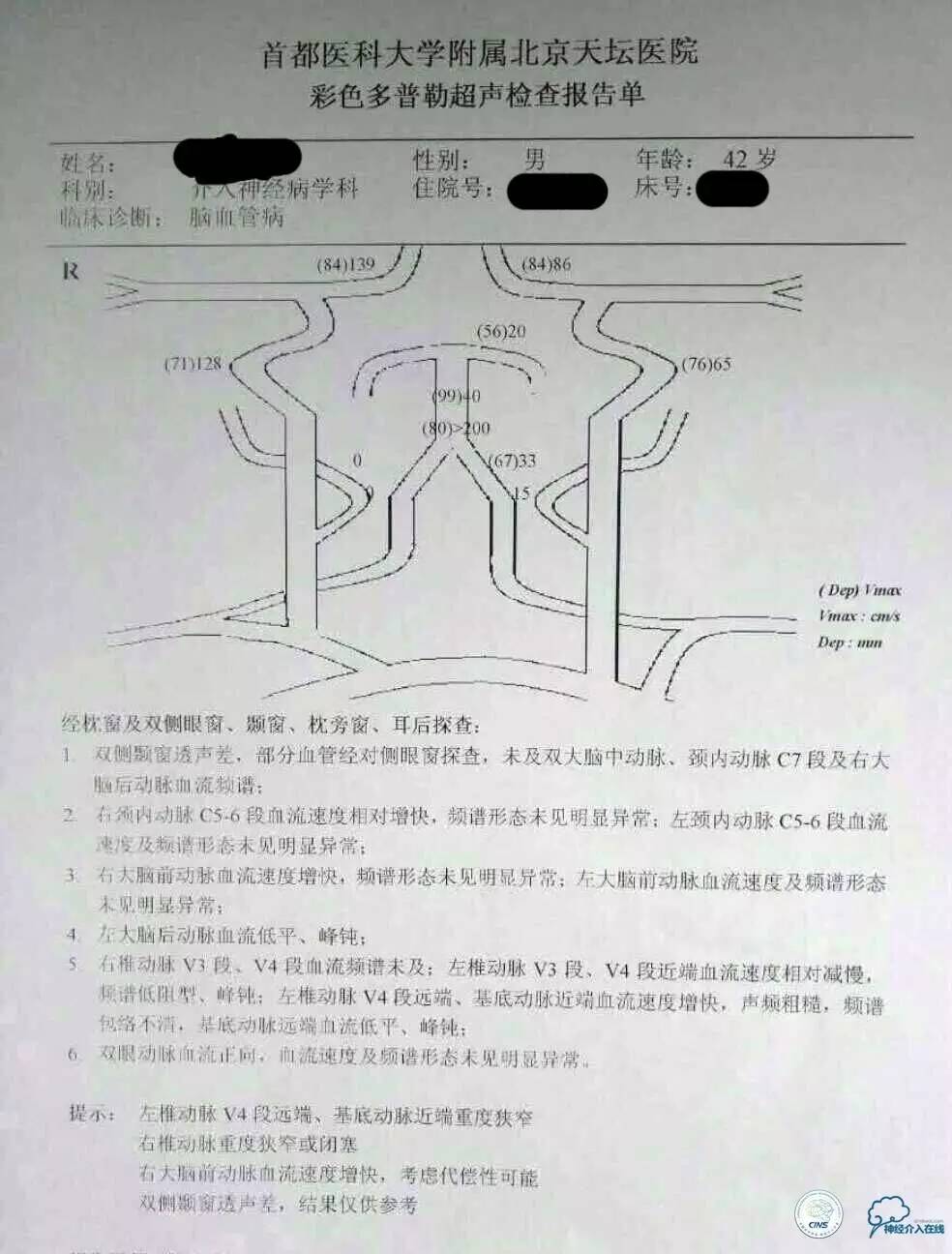 天坛周记|左椎V4段-基底动脉交界区狭窄的支架治疗