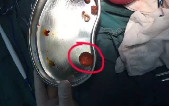 小孩子误吞珠子危害,小孩误吞塑料小珠子怎么办