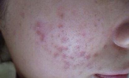 挤痘有刺痛感,挤痘为什么会留痘坑