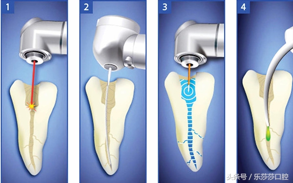 满口蛀牙的图片,满口蛀牙毁终身