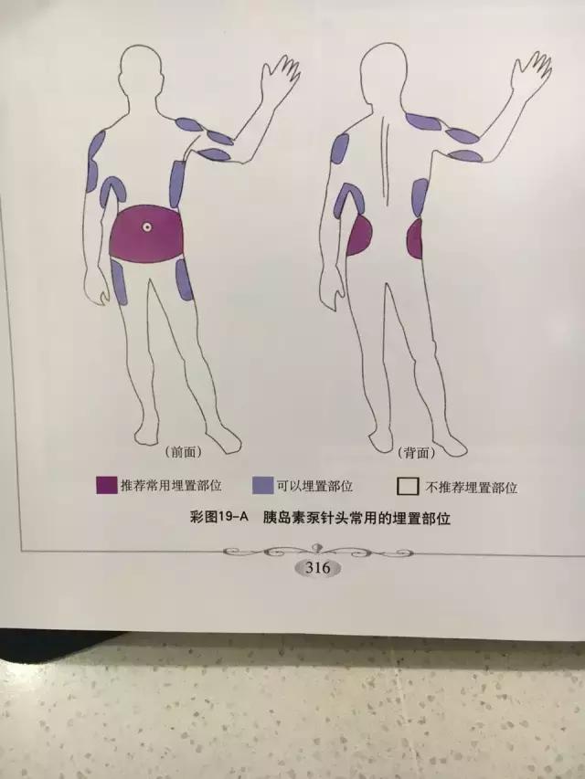 糖友讨论：偏瘦、戴泵的糖宝埋置针头部位