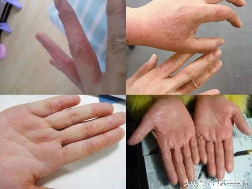 免洗消毒洗手凝胶有没有危害,手脏能直接用免洗洗手消毒凝胶吗