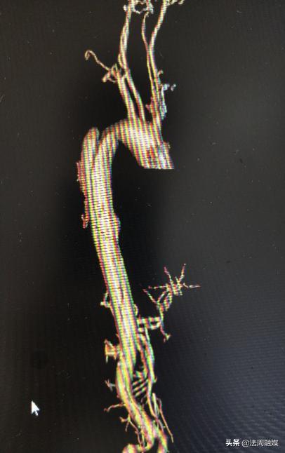 岳阳市一医院主动脉夹层手术,介入微创治疗a型主动脉夹层