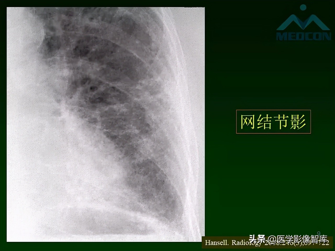肺弥漫性网状影,两肺小叶间隔增厚可见网状模糊影