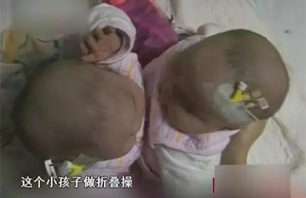 中国首例坐骨连体双胞胎现状,坐骨连体双胞胎多大分离