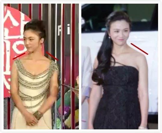 明星溜肩矫正前后,缩肩的危害