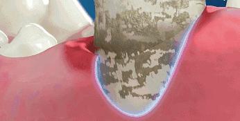 刷牙去牙垢烟垢黄牙最有效方法,刷牙多久才能消除牙黄味