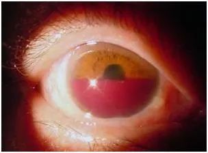 让孩子远离眼外伤的方法,儿童眼外伤