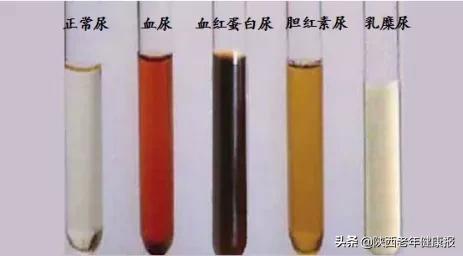 尿液存在身体哪个器官,尿液可以知道身体哪些情况