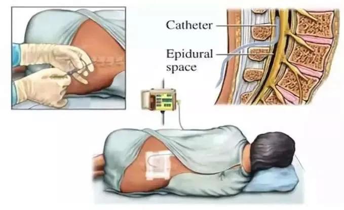 哪个说生娃儿就一定要痛？这些关于分娩镇痛的谣言太坑人！