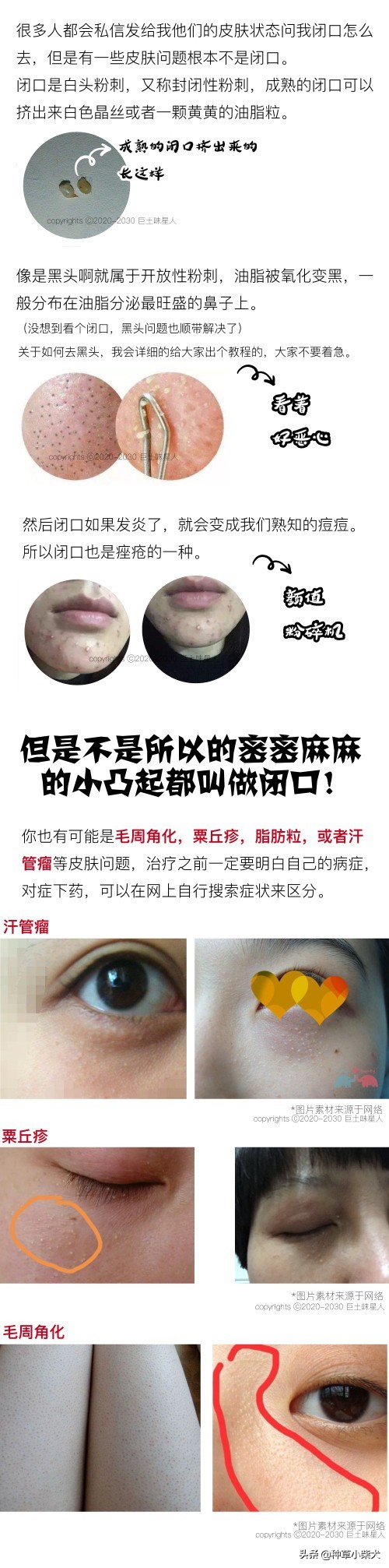 “土”血总结｜保姆级去闭口教程合集