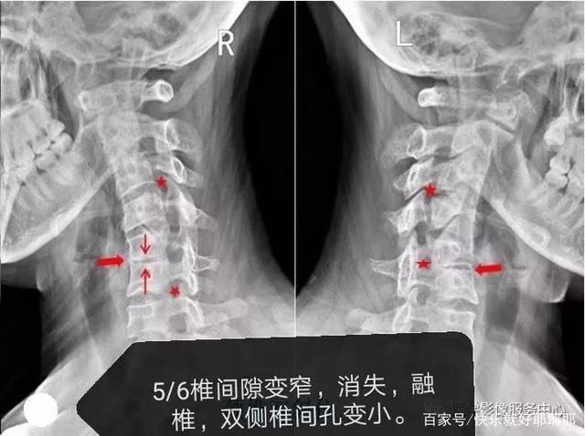 颈椎腰腿痛治疗手法,老中医治疗颈椎腰腿疼