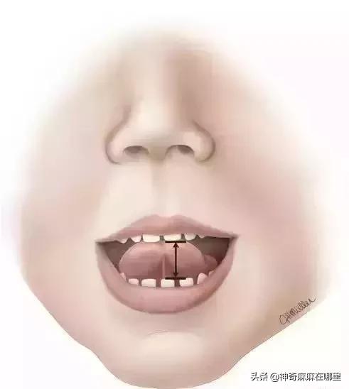 宝宝的舌头有点红怎么回事,宝宝的舌头有红点