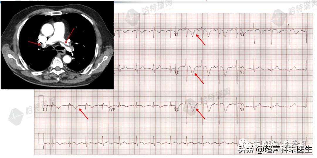 t波倒置9个真相图解,t波倒置判断口诀
