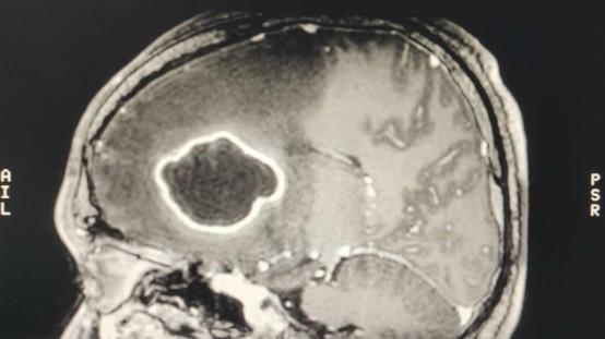 挤痘一时爽,挤完脑脓肿?|健康问答133期