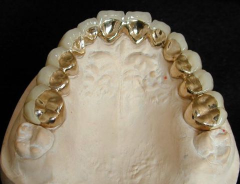 假牙的种类及价格详细介绍图片,目前国内最好的假牙是多少钱