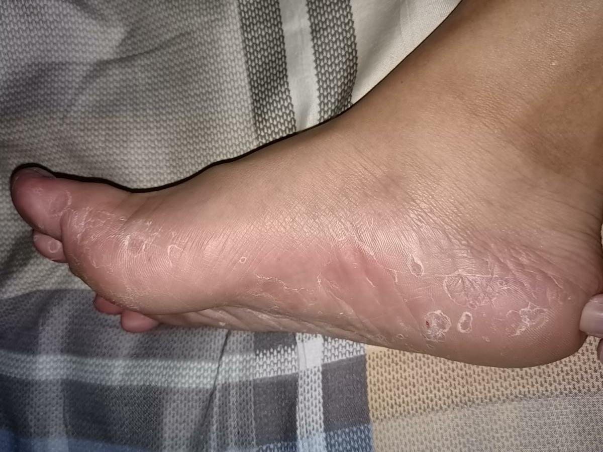 针灸根治足癣,足癣能根治吗会复发吗