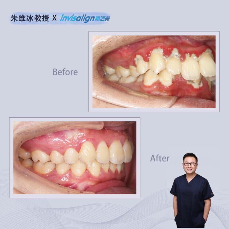 隐适美牙齿拥挤矫正真实案例,南京朱维冰