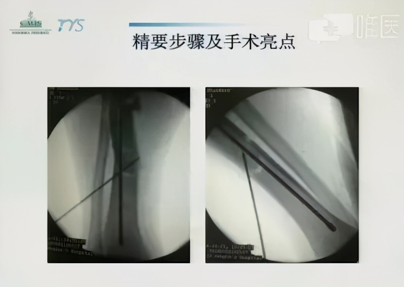 单纯的腓骨轻微骨折怎么治疗,70岁的人胫腓骨骨折了怎么治疗好