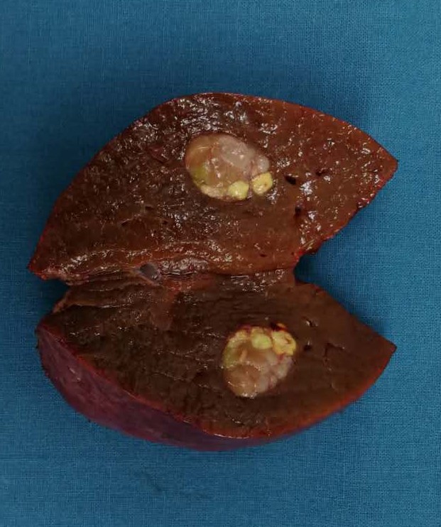 乙肝大三阳需要戒烟吗,乙肝患者应无条件忌酒