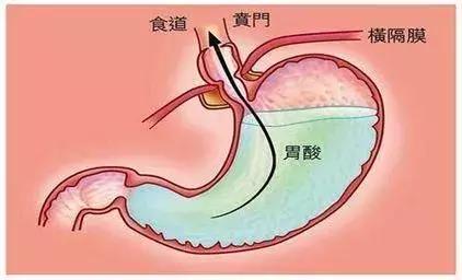 胃酸怎么办最有效的办法,胃酸怎么办吃什么水果