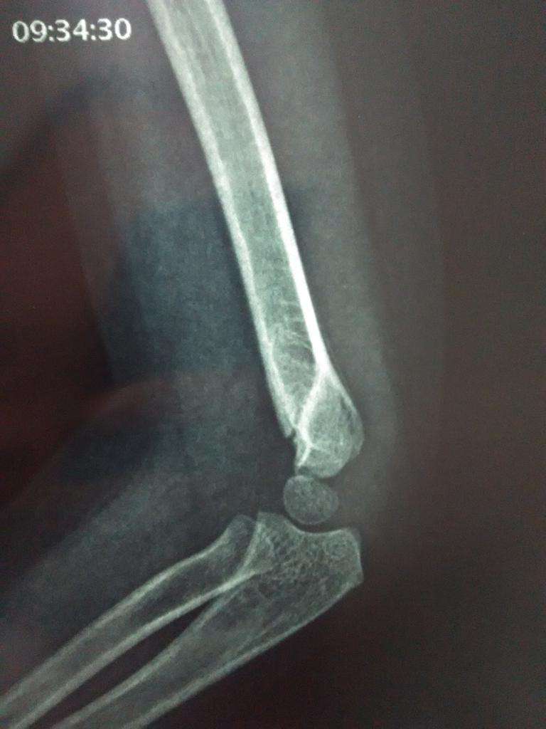 宝宝骨折以后的处理方法详解,宝宝骨折怎么修复